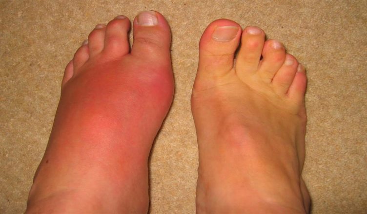 Eat high-fiber diet to cut inflammation caused by gout
